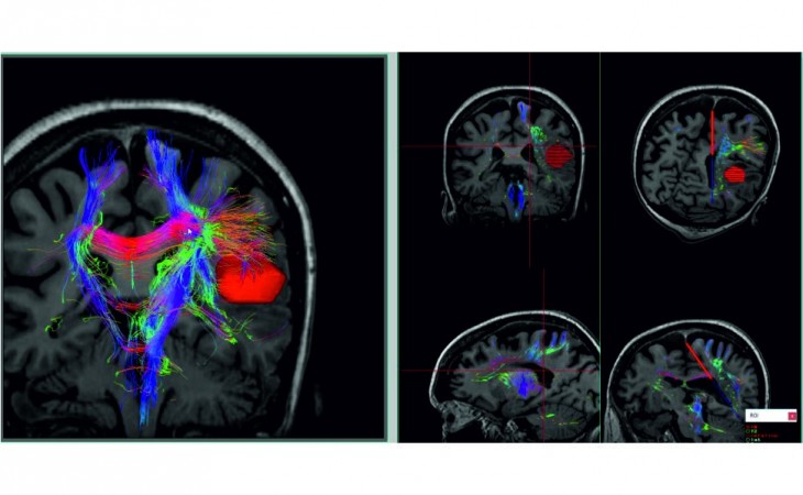 Neuronavegador Tracker