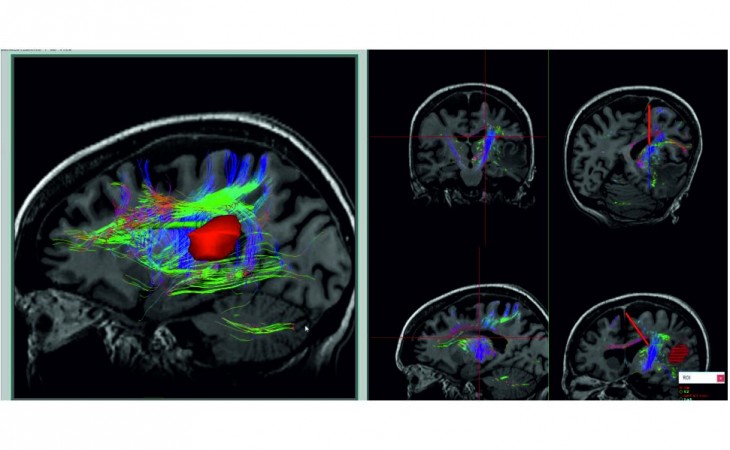 Neuronavegador Tracker