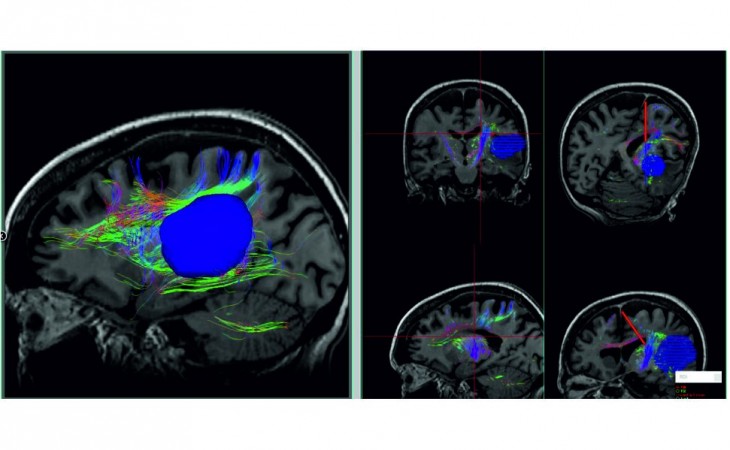 Neuronavegador Tracker